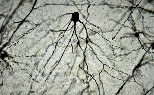 Una nueva terapia molecular permite tratar el ictus en su fase aguda